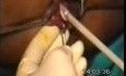 Kriochirurgia hemoroidów
