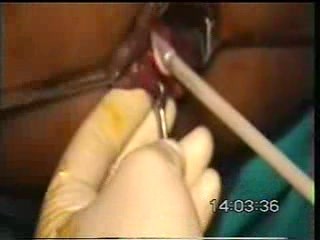 Kriochirurgia hemoroidów