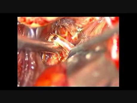 Klipsowanie tętniaka podziału tętnicy środkowej mózgu