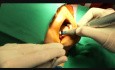 Implantacja w żuchwie w 4 ćwiartce