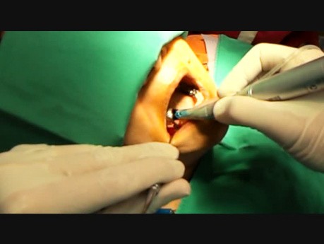 Implantacja w żuchwie w 4 ćwiartce