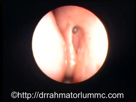 Endoskopowe oglądanie nosa po udanym endoskopowym zespoleniu workowo-nosowym
