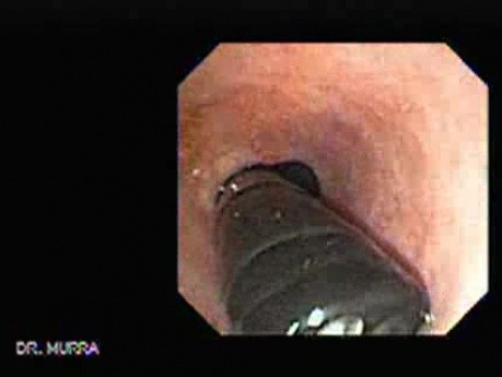Górny odcinek przewodu pokarmowego - endoskopia - sekwencja video (1 z 6)