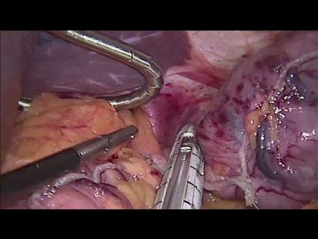 Laparoskopowa resekcja dna żołądka w przebiegu GIST
