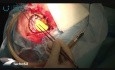 Aplikacja matrycy TachoSil celem plastyki opony twardej podczas operacji klipsowania tętniaka tętnicy środkowej mózgu