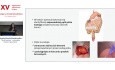 "Ghost ileostomy" - potencjalne korzyści i ograniczenia