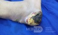 Diabetic Heel Ulcer with Achill's Infection