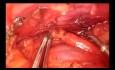 Tymektomia (thymectomy) i resekcja grasiczaka (thymomectomy) z dojścia podmostkowego