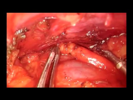 Tymektomia (thymectomy) i resekcja grasiczaka (thymomectomy) z dojścia podmostkowego