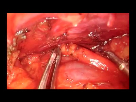 Tymektomia (thymectomy) i resekcja grasiczaka (thymomectomy) z dojścia podmostkowego