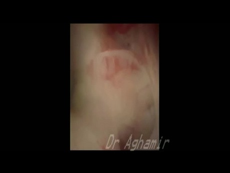 Ureterorenoskopia z giętkim endoskopem z powodu kamicy w nerce gąbczastej