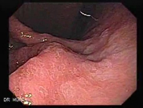 Rak żołądka - metaplazja jelitowa - endoskopia (3 z 7)