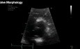 Echokardiograficzna ocena zwężenia aorty