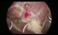 Histeroskopowa resekcja mięśniaka