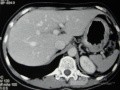 Obraz endoskopowy raka włóknistego żołądka obejmującego dno, trzon i część przedodźwiernikową (18 z 47)