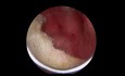 Przezcewkowa elektroresekcja gruczołu krokowego (TURP) - ropień prostaty (gruczołu krokowego)