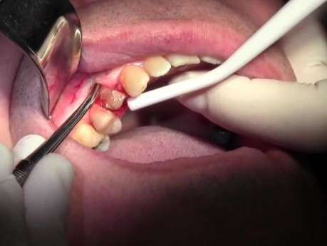 Ekstrakcja zęba 1-5 z jednoczesnym przeszczepem kostnym - d-PTFE - kiretaż otwarty