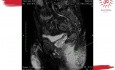 Przetoka odbytu o typie podkowy (horseshoe fistula) z ropniem kulszowo-odbytniczym - MRI przed- i pooperacyjne