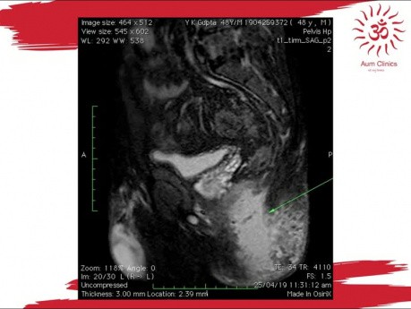 Przetoka odbytu o typie podkowy (horseshoe fistula) z ropniem kulszowo-odbytniczym - MRI przed- i pooperacyjne
