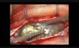 Mikrochirurgiczne usunięcie wewnątrzrdzeniowej torbieli skórzastej