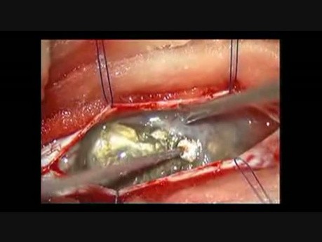 Mikrochirurgiczne usunięcie wewnątrzrdzeniowej torbieli skórzastej