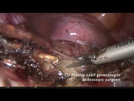 Całkowita laparoskopowa histerektomia przy macicy o znacznych rozmiarach - rady i triki
