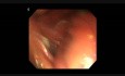 Endoskopowa dyssekcja podsluzówkowa w leczeniu podśluzówkowego guza żołądka