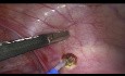 Endometrioza