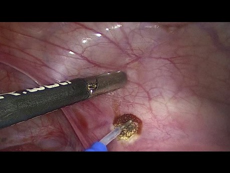 Endometrioza