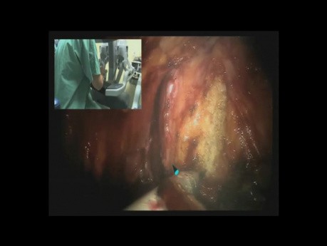 Prostatektomia robotowa HD - DaVinci - część 1