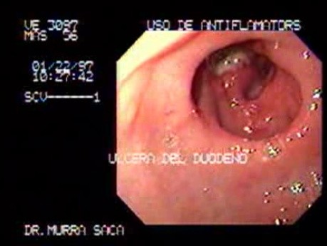 Wrzody dwunastnicy i zniekształcona opuszka