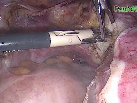 Całkowite wycięcie macicy techniką laparoskopowoą