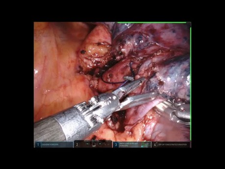 Anatomiczne usunięcie segmentu płuca.