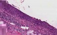 Rak in situ - histopatologia - płuco, oskrzele