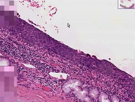 Rak in situ - histopatologia - płuco, oskrzele