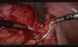 Laparoskopowe usunięcie torbieli dermoidalnej jajnika