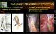 Laparoskopowa cholecystektomia 