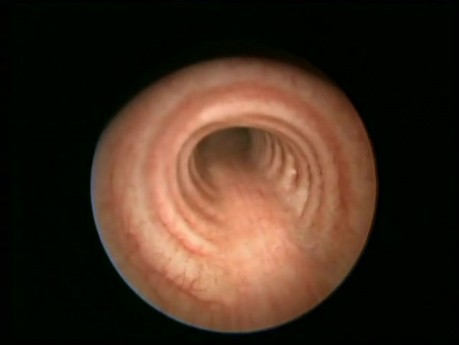 Anatomia prawidłowa krtani, tchawicy i oskrzeli dorosłego człowieka - obraz endoskopowy
