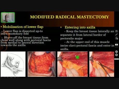Radykalna mastektomia - teoretyczne aspekty 