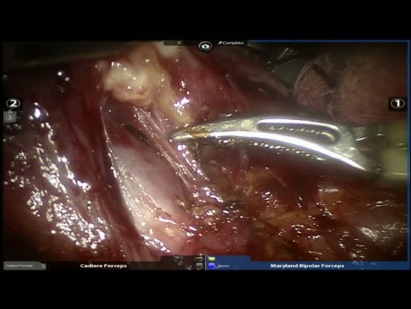 Segmentektomia anatomiczna z użyciem robota