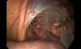 Hernioplastyka prawostronna metodą laparoskopową