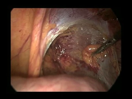 Hernioplastyka prawostronna metodą laparoskopową