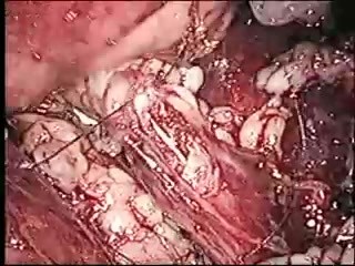 Laparoskopowa ureterolitotomia retroperitoneoskopowa - przecięcie moczowodu metodą laparoskopowa z dostępu pozaotrzewnowego