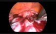 Laparoskopowa operacja obustronnych przerzutów w jajniku