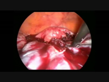 Laparoskopowa operacja obustronnych przerzutów w jajniku