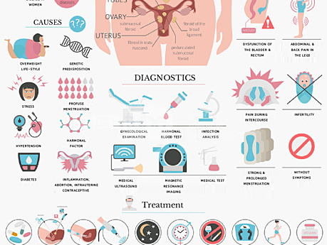 Mięśniaki macicy- objawy, przyczyny, diagnostyka