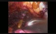 Całkowite odcięcie prostaty - laparoskopowa radykalna prostatektomia