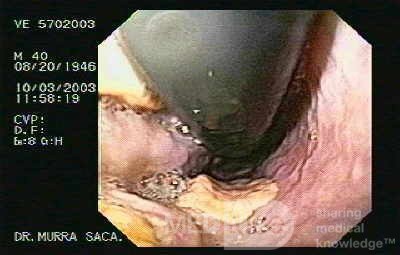 Ostre krwawienie z żylaków - obraz wpustu żołądka w inwersji endoskopowej w celu oceny podwiązywania