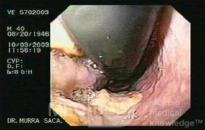 Ostre krwawienie z żylaków - obraz wpustu żołądka w inwersji endoskopowej w celu oceny podwiązywania