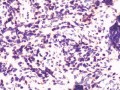 Chłoniak nieziarniczy z komórek B typu MALT  (7 z 7)